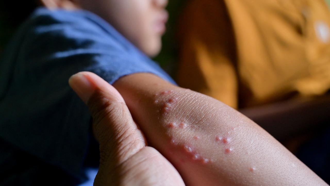 Molusco contagioso